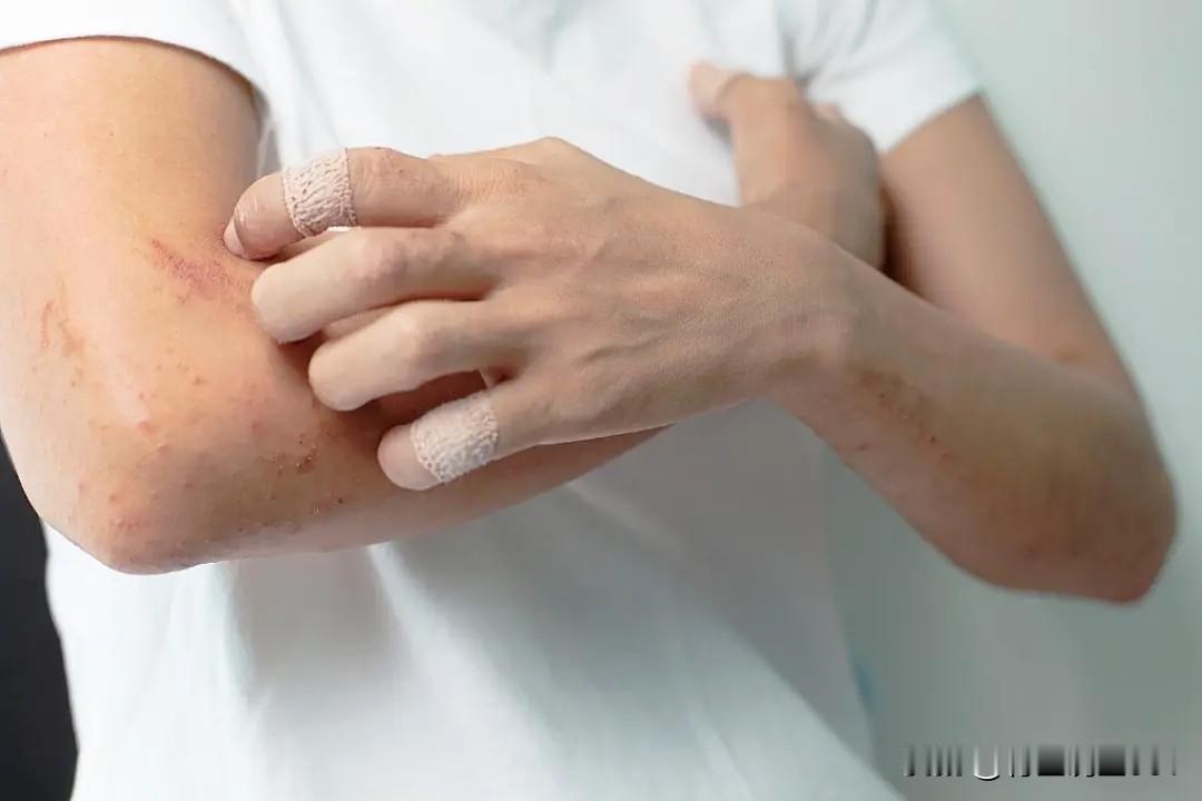 反复瘙痒起疹？5个经典中成药调理慢性湿疹，温和祛湿不刺激，一文读懂慢性湿疹