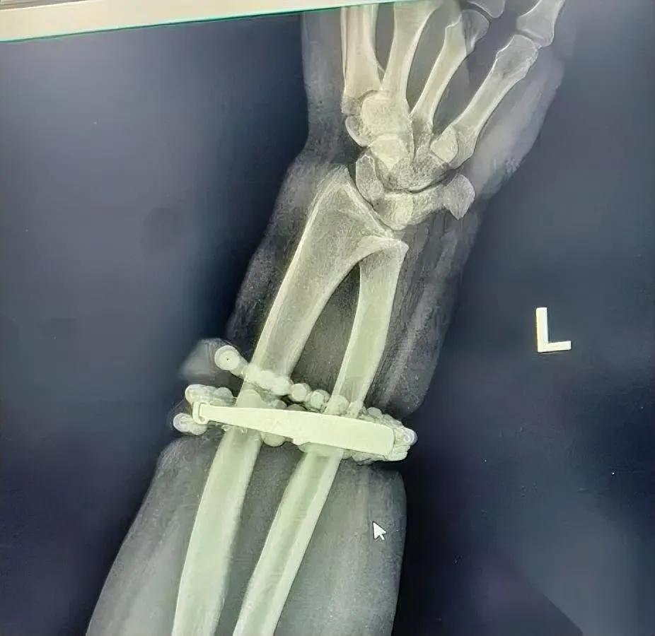 手镯嵌进肉里?太吓人!她戴了十年的首饰竟成“凶器”33岁的龚女士,结婚时