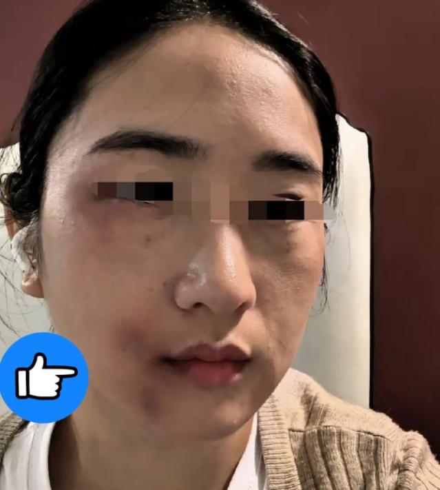 昨天被丈夫打了。我弟弟知道以后，从家里拿了根钢管赶来我家。丈夫打开门，弟弟没说话