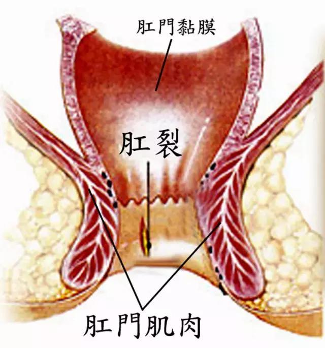 肛裂和痔疮, 区别在哪里?