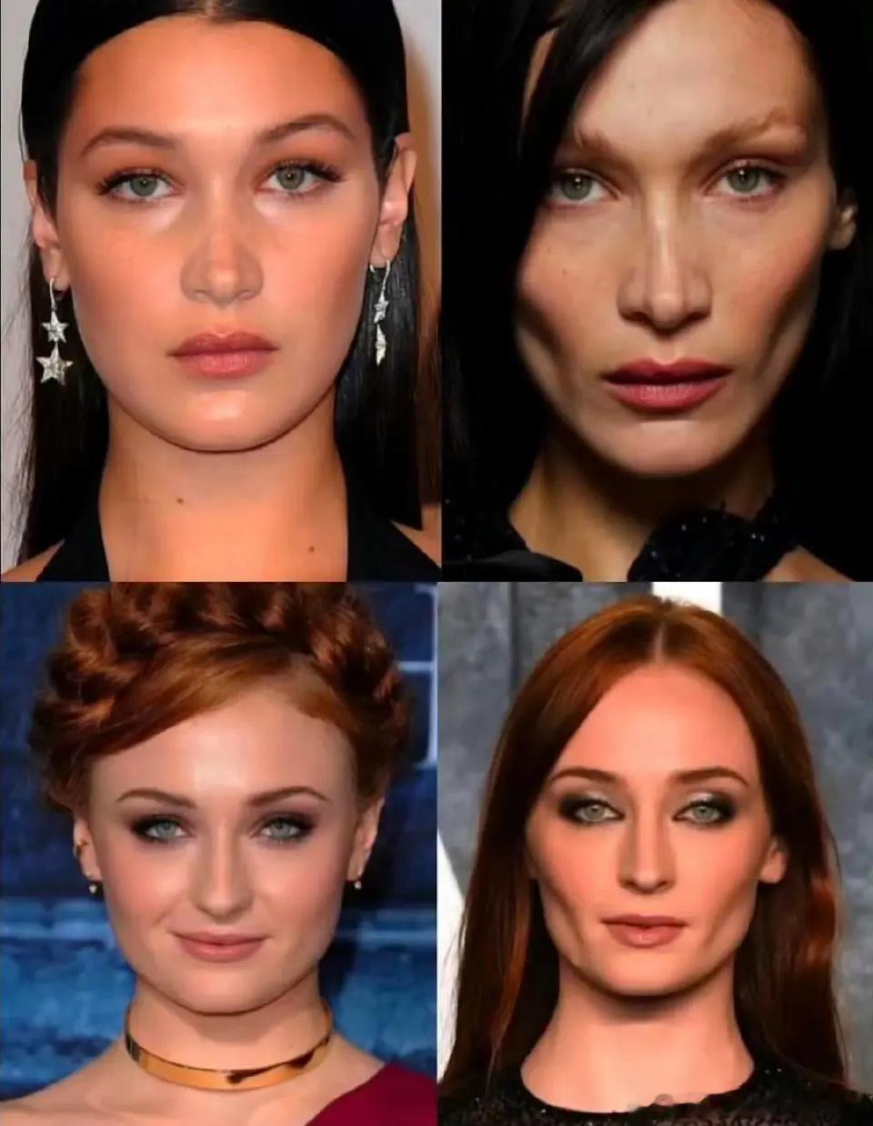 欧美这种取颊脂垫的嗦腮审美好看吗