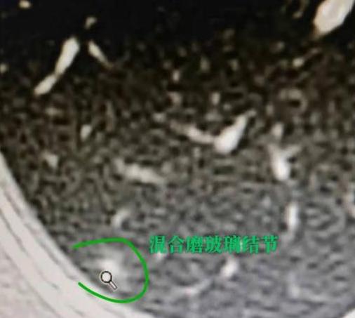 今天门诊碰到个33岁的姑娘，特别年轻，一进来就慌慌张张的，手里攥着一堆检查单。她