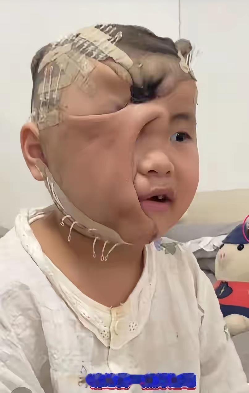 每个孩子都是爸妈的心头肉，谁愿看娃遭这份罪？梓涵从小被皮肉痣缠上，一次次躺上手术