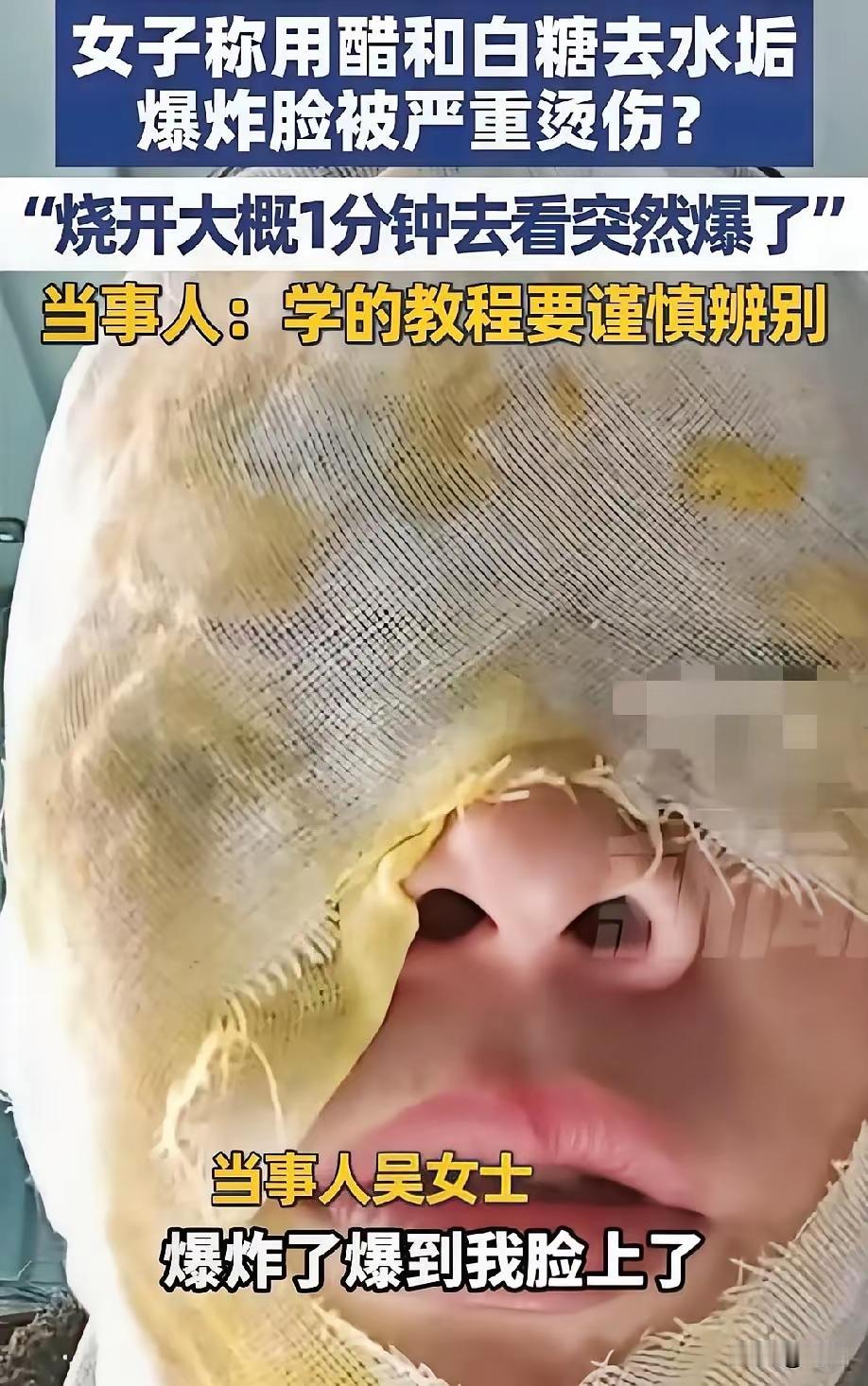 女子清洗水垢被炸伤！切记：糖升温！醋生气！河北一女子用糖和白醋去水垢，水开后
