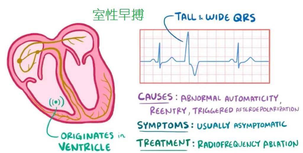 室性早搏3万多次，要做手术吗？一位患者咨询。室性早搏是最常见的心律失常之一，我们