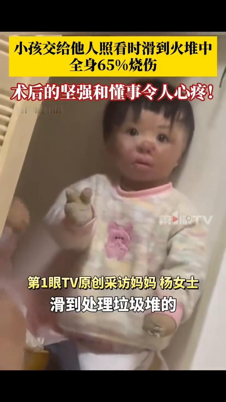 小孩交给他人照看时滑到火堆中，全身65%烧伤，术后的坚强和懂事令人心疼！第1眼