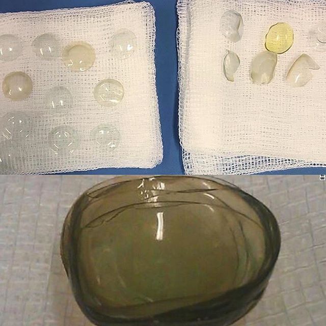 医生从一名女性眼睛里取出27副隐形眼镜！！一位67岁的妇女计划进行常规白内障手术