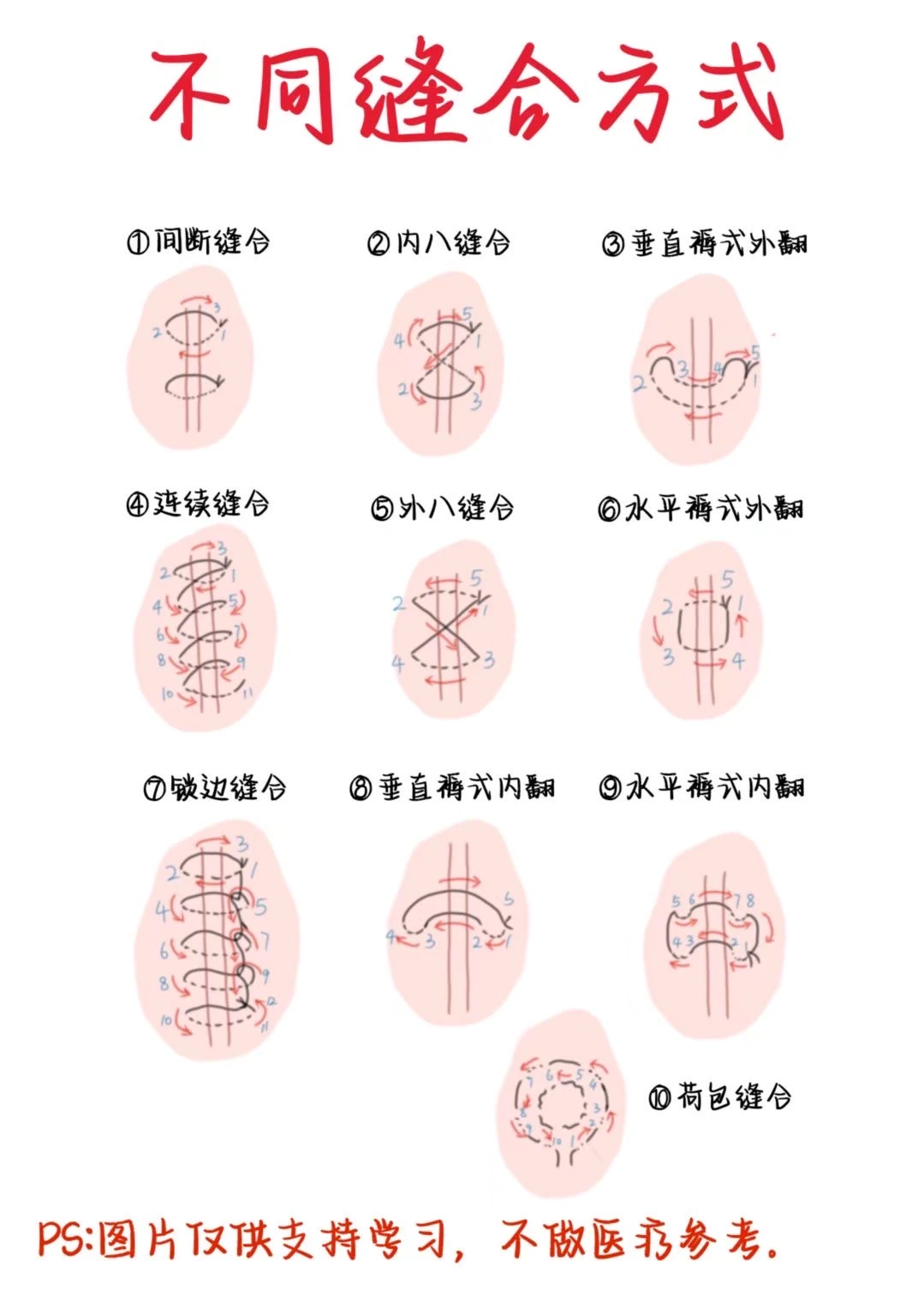 医学生笔记——不同缝合方式