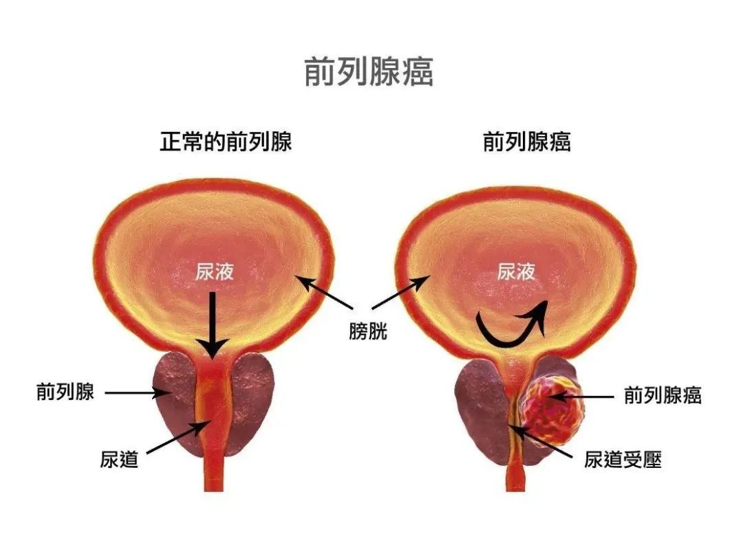 前列腺癌新辅助内分泌治疗停药注意事项：一、停药时机（核心）达标再停：PSA明