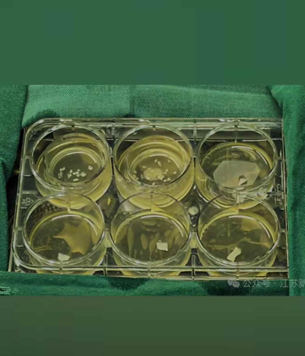 近日，江苏发生了一件特殊的医疗事件，江苏省人民医院和南京儿童医院联手，成功为一名