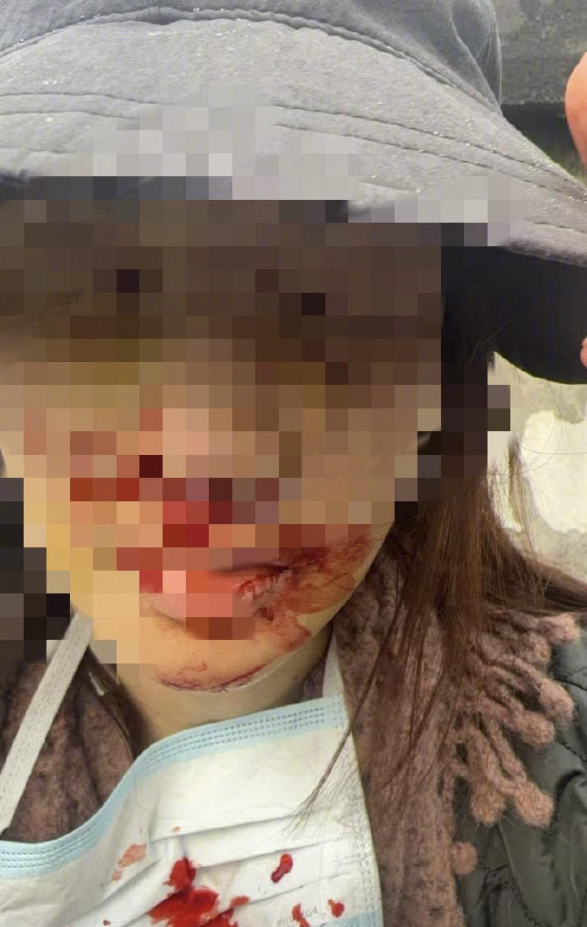 金晨晒伤脸佐证为何急于离开车祸现场：系去医院急救，毕竟是艺人，脸为职业财产。助