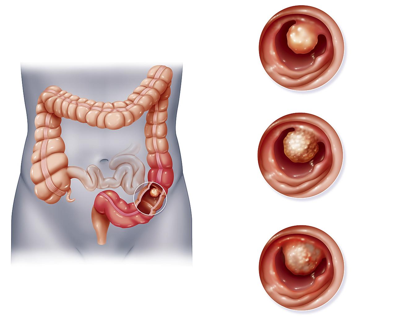 医生提醒：腹部若出现5种异常症状，可能是结肠炎信号，别忽视上周接诊了一位32