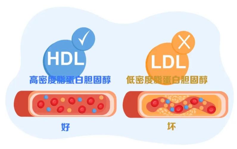 低密度脂蛋白要低于多少，斑块才能不发展？医生告诉你答案！刘先生是一位50多岁