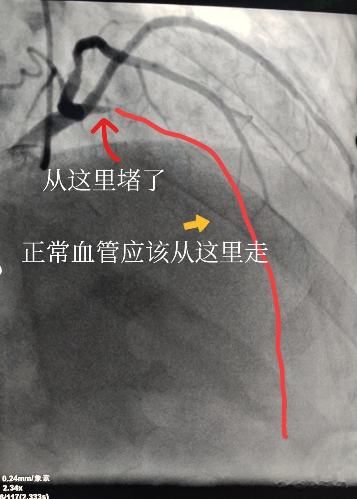 血管狭窄、堵塞能通开吗?能开通。来看看我前段时间做的一个冠状动脉闭塞开通的病例。