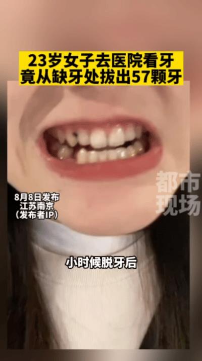 “万万没想到！”江苏，一位20多岁的女孩因为小时候有颗牙脱落后没长出来，她没在意