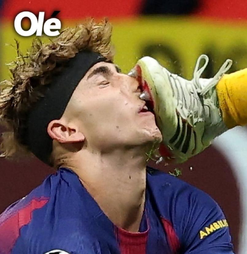 马竞1：2巴萨的比赛太多争议，而费尔明被马竞门将踹的鲜血直流的场面让人不敢直视，