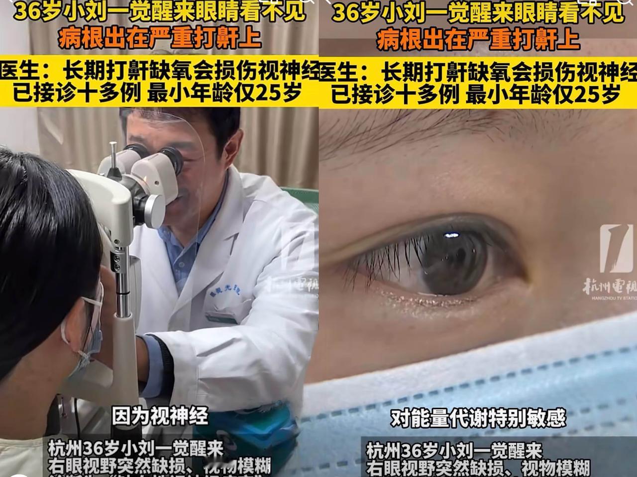一觉醒来，睡觉爱打呼噜的人天塌了！近日，杭州36岁的小刘一觉醒来，发现自己右眼看