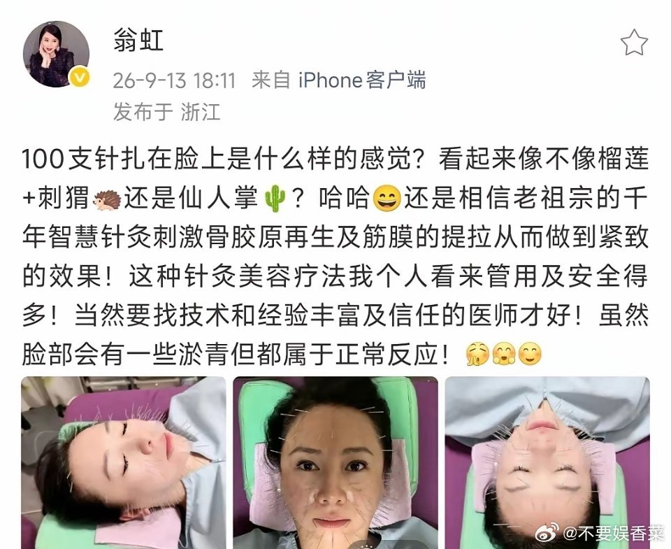 翁虹去做“针灸美容”保养，脸上密密麻麻扎了100针，她说自己像刺猬一样，为了在5