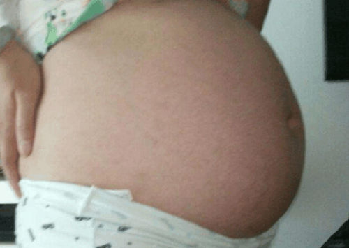 3月宝宝奶粉过敏妈妈高价买羊奶粉喂, 脱水送医后, 医生: 真有钱