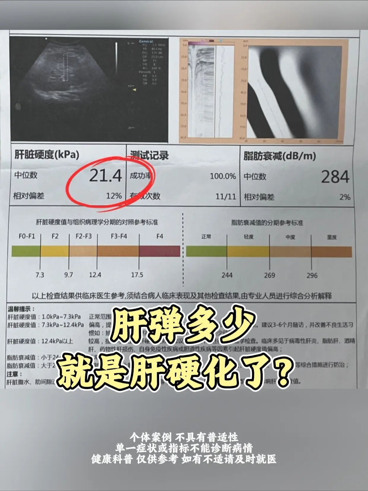 肝弹多少就是肝硬化了？。很多朋友拿到肝弹报告就慌了：这个数字到底多少算...