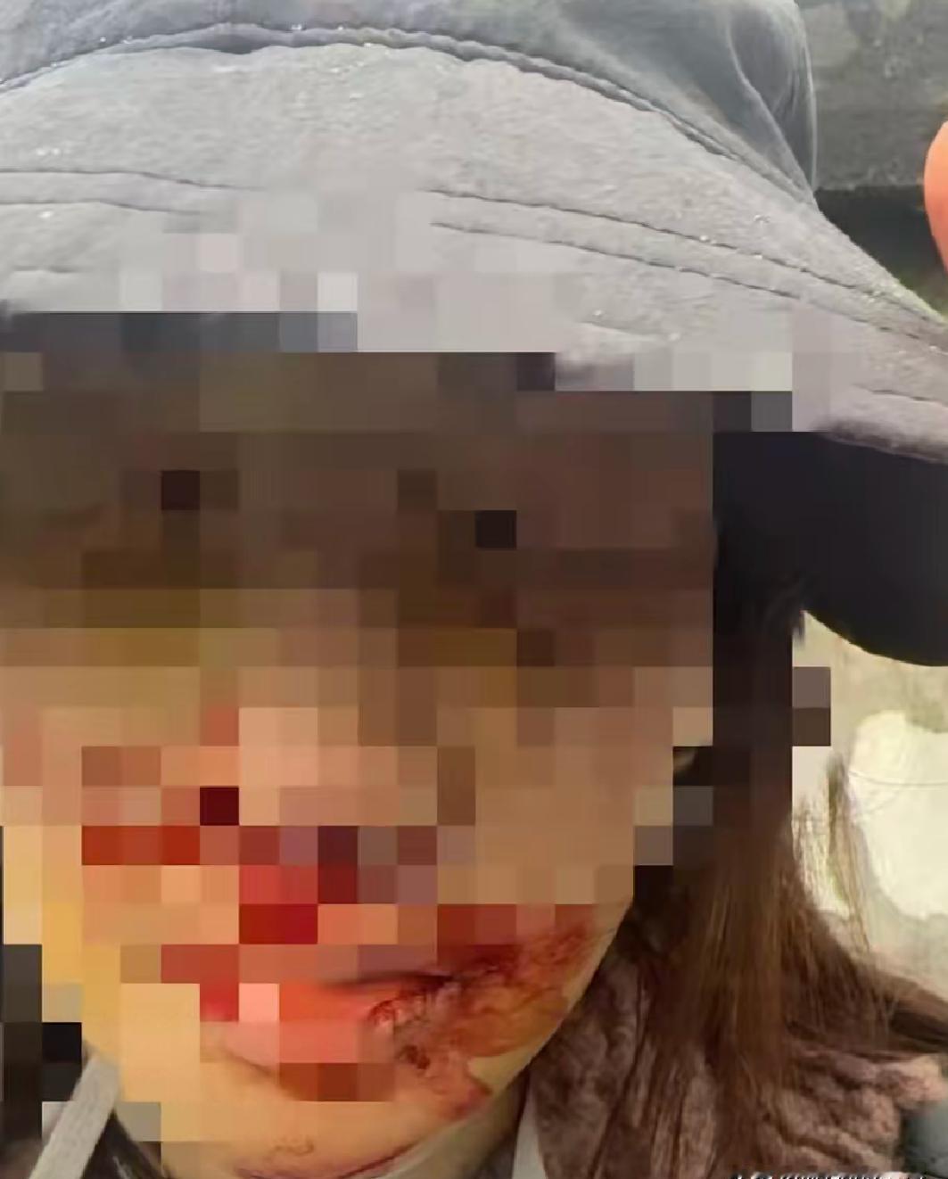 脸上的血还没干，缝针的线还热乎着，金晨就被按上了“肇事逃逸”的罪名。一帮人键盘