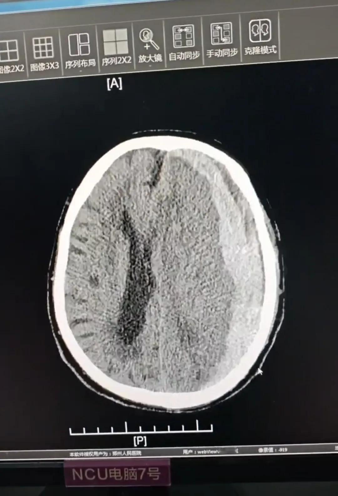 老爸脑溢血进ICU，今天是第8天了，也下胃管了，也上呼吸机了，到现在没有苏醒的迹