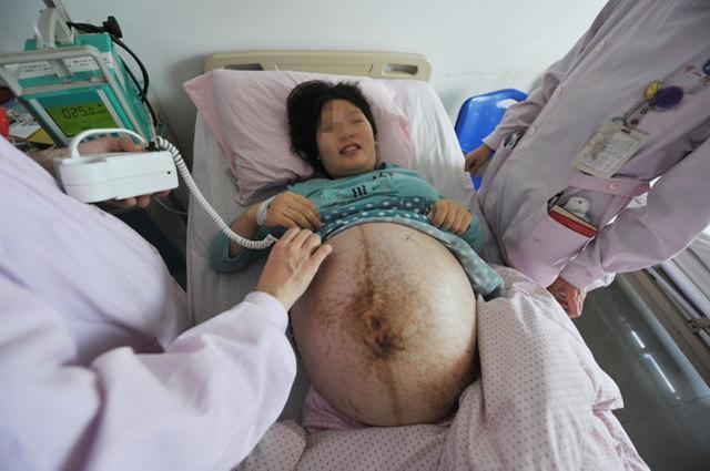 孕3个月检查出五胞胎, 孩子出生后, 宝妈喜忧参半