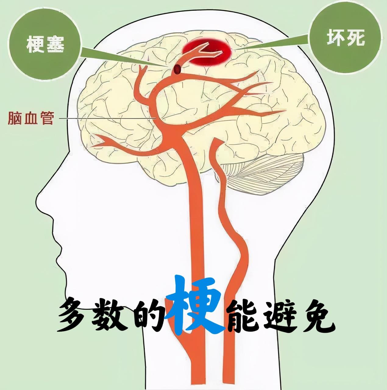 多数的梗，都有“懒”的影子我不是医生，几十年也看到了很多心梗、脑梗事例，家人