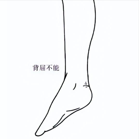 偏瘫足下垂别绝望！除了锻炼，这两个方法也很管用！方法一：足托足托就像一个外