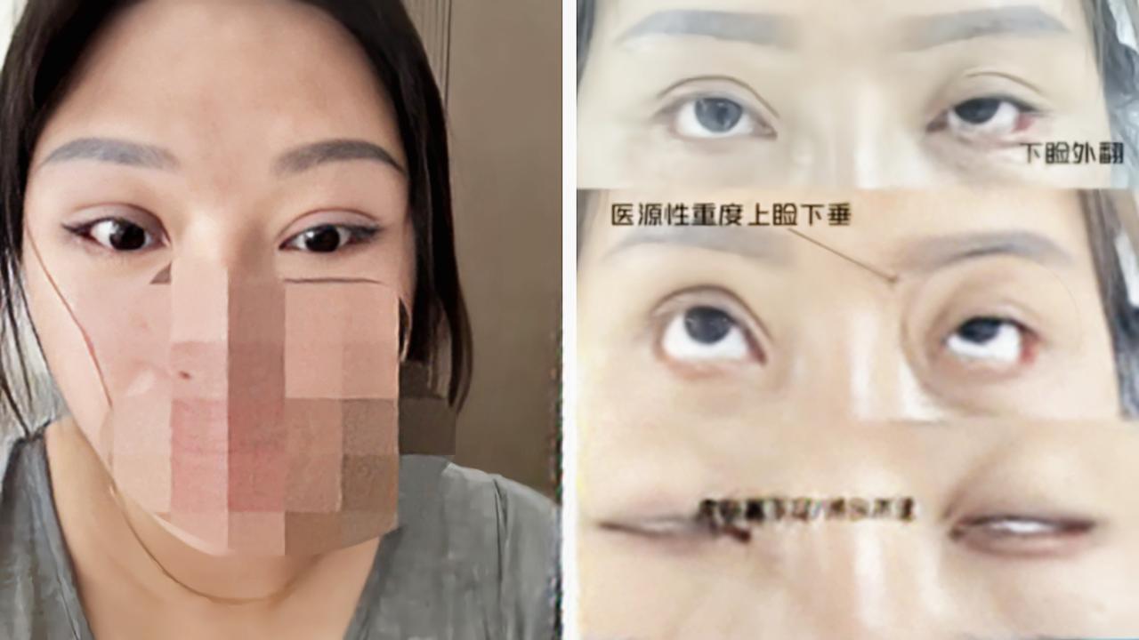 江苏，这位女子太绝望了！信了老乡的话，花一万多做了双眼皮手术，结果落了个九级终身