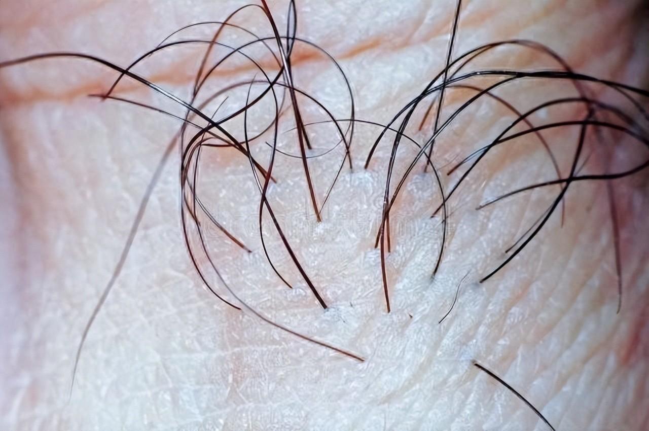 为何有些女性私密处没毛？医生：私处毛发的3个作用，别害羞私处有没有毛，在妇科