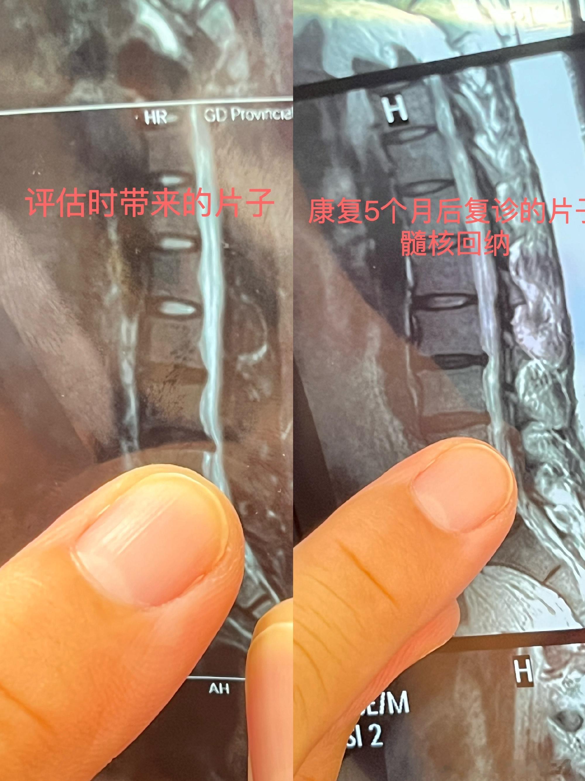 腰椎间盘突出﻿﻿之前一直讲，腰突是有概率回去的，我们线下就有腰突髓核回纳的患者