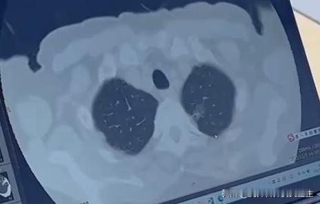 不抽烟也得肺癌？年轻女性患肺腺癌的真相让人意外！