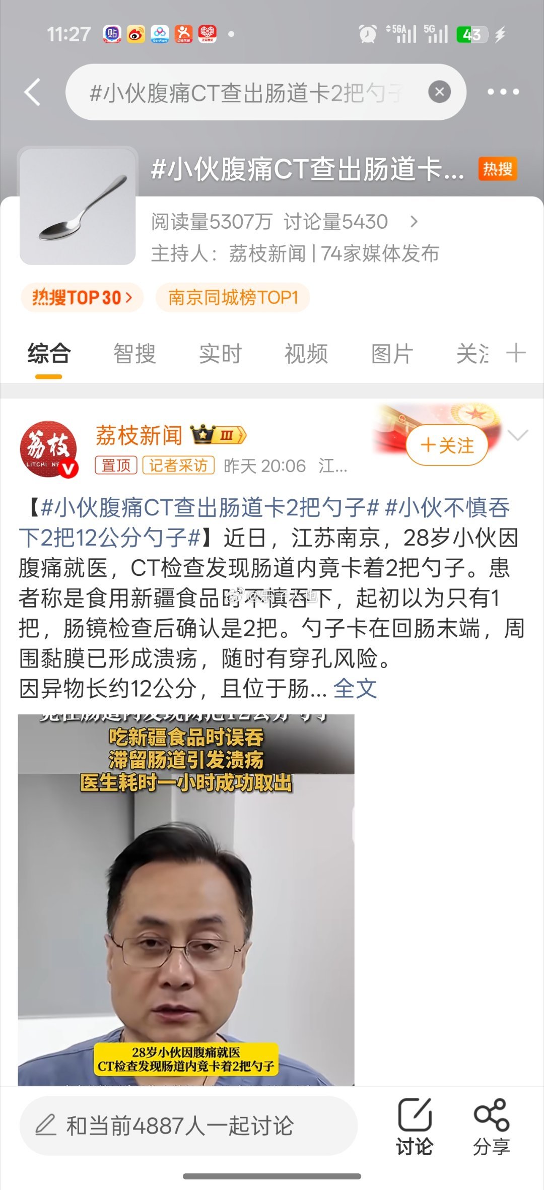 小伙腹痛CT查出肠道卡2把勺子从上面进去还是下面进去的我自有判断