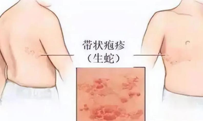 大四女生吃甲钴胺片治带状疱疹，半年后体检结果令医生意外一位大四女生患上带状疱