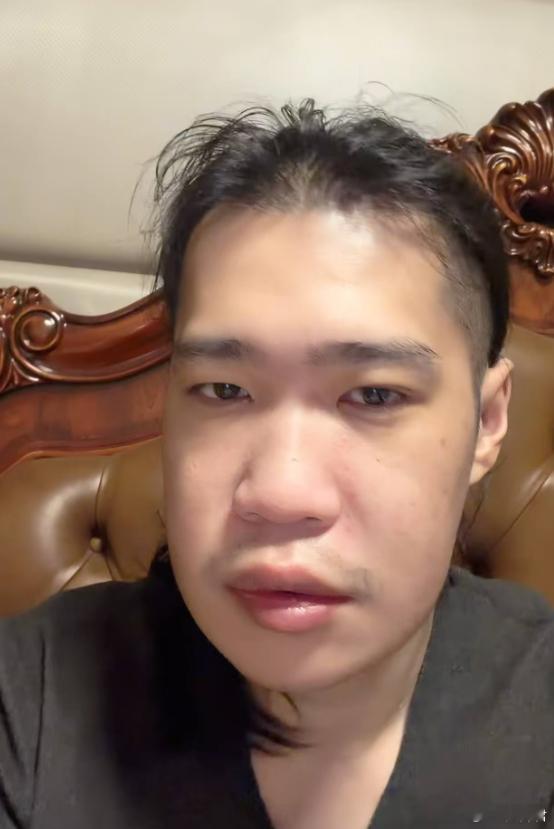 PIS晒出了自己拔牙32颗之后的肿胀照片，卧槽，这脸肿成长方形了dota