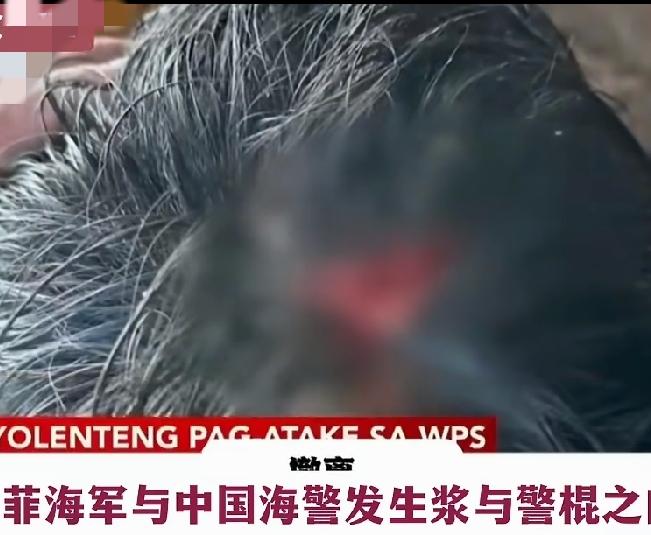 菲媒证实两名士兵受伤!头部缝了四针，手臂手指也伤了，冷兵器交锋，菲方败！一