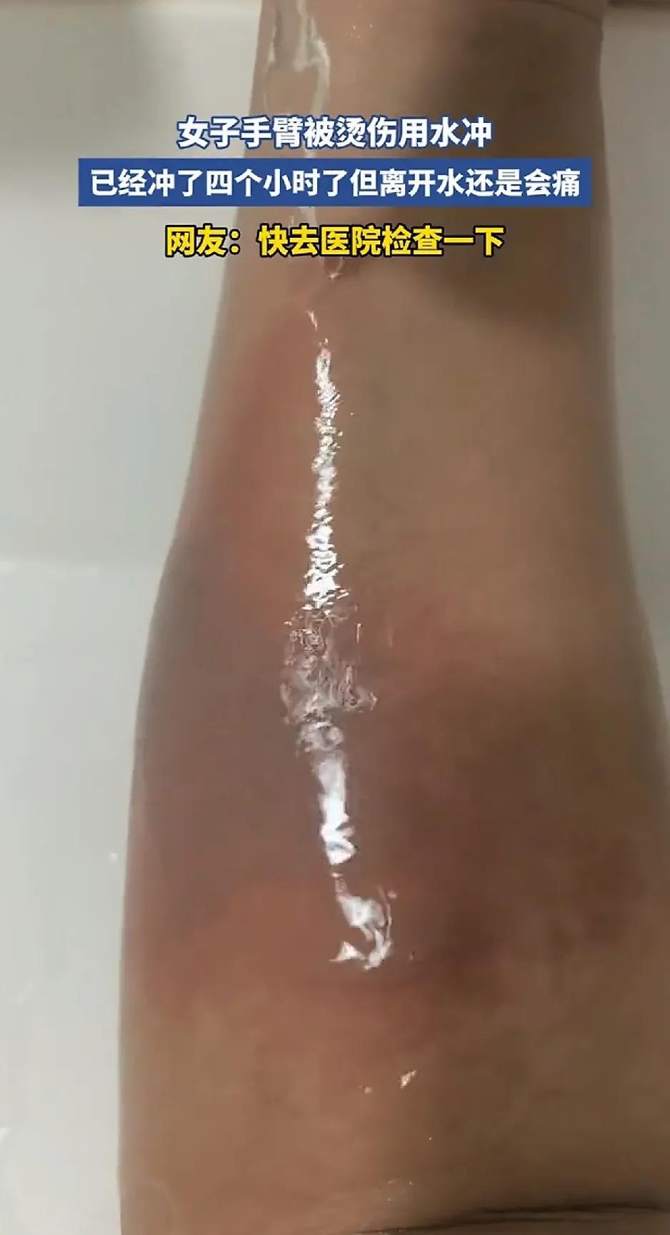 山东一名女子手臂意外烫伤，为了缓解钻心疼痛感，打开流动自来水持续冲洗烫伤部位，整