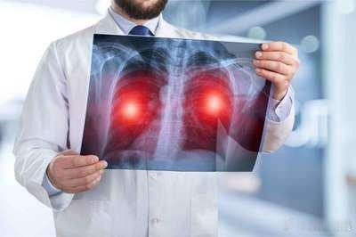 消失的Y染色体：男性肺癌患者的双刃剑！随着科学界对男性细胞中Y染色体丢失现象的关