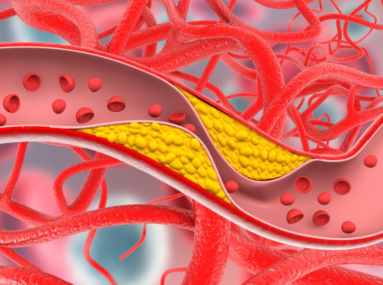 三通汤堪称心脑血管的黄金方，除瘀血，通血管，防脑梗，效如桴鼓心脑血管问题早已