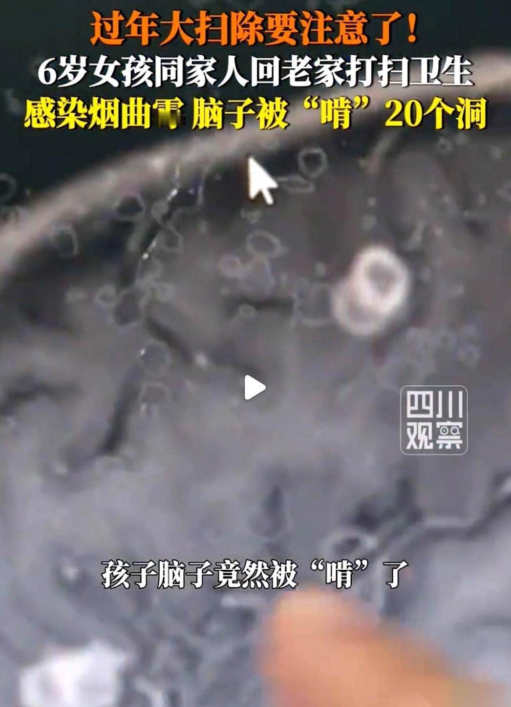 一个6岁的小姑娘，脑子里被“啃”了20多个洞。真的，就像被虫子蛀空了一样，CT