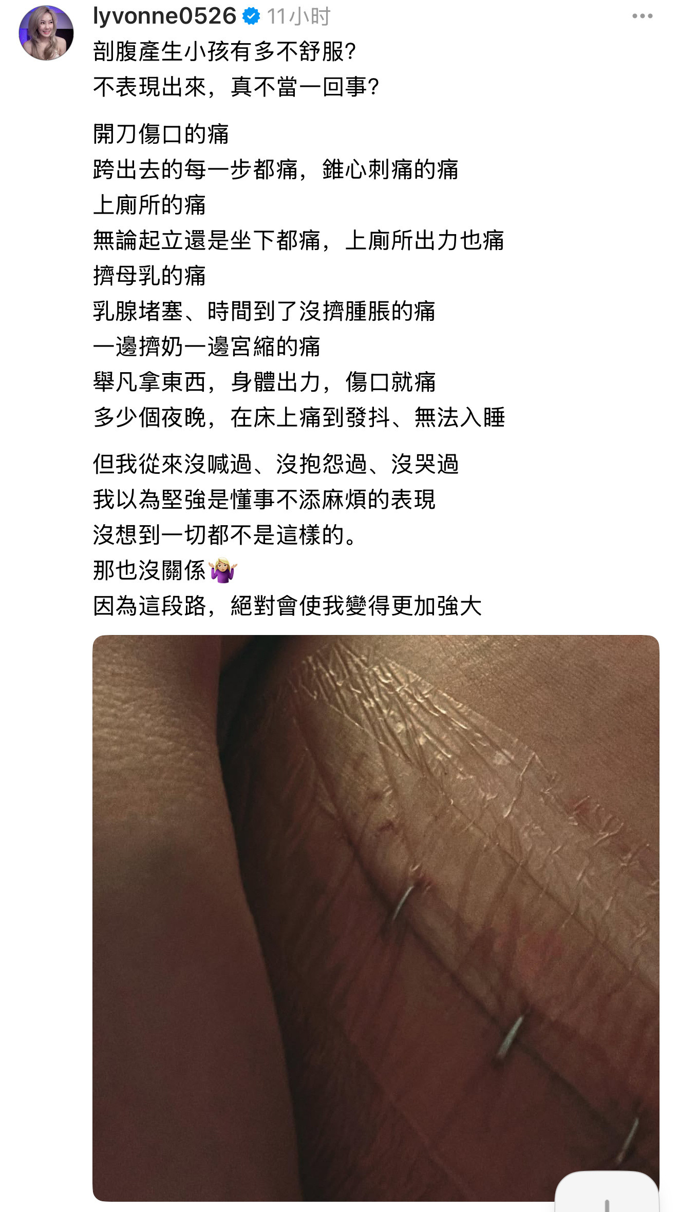 刘雨柔po自己剖腹产伤口照片🌚剖宫产生孩子有多不舒服？不表现出来，真不当一回