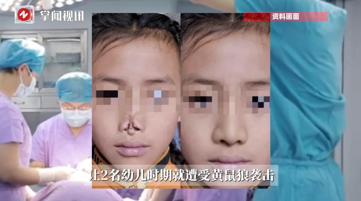 “这才是真正的专家！”四川甘孜，孩子因为小时候睡觉时，父母没有注意而被黄鼠狼咬掉