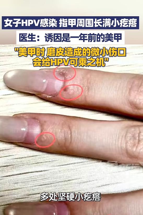 “太吓人了！”5月9日报道，浙江杭州，一女子发现她的指甲周边，长了许多粗糙坚硬的