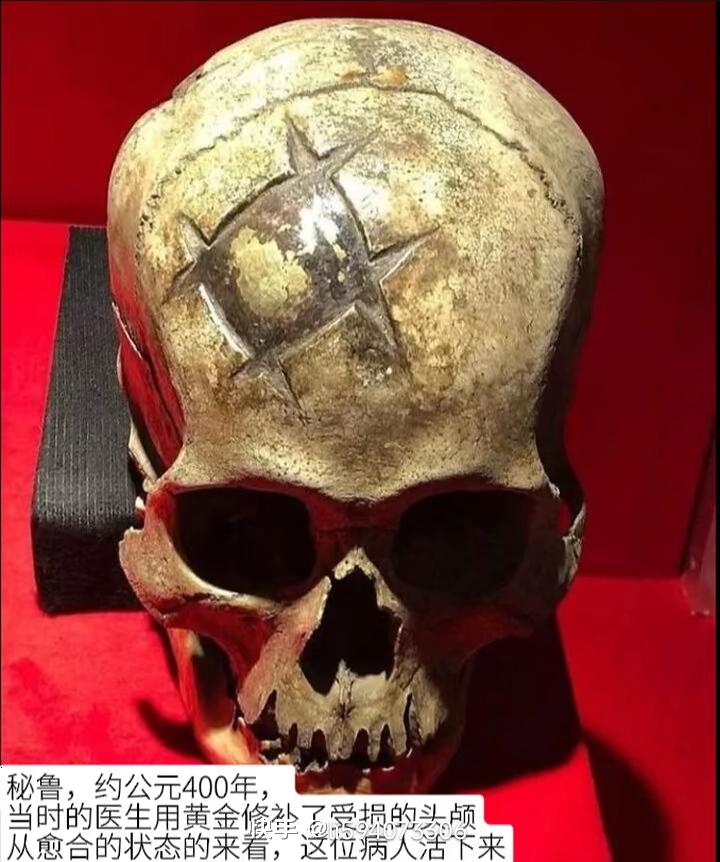 看到这个5000年前做过手术的头骨，简直太震撼了！1995年春夜，山东考古所发现