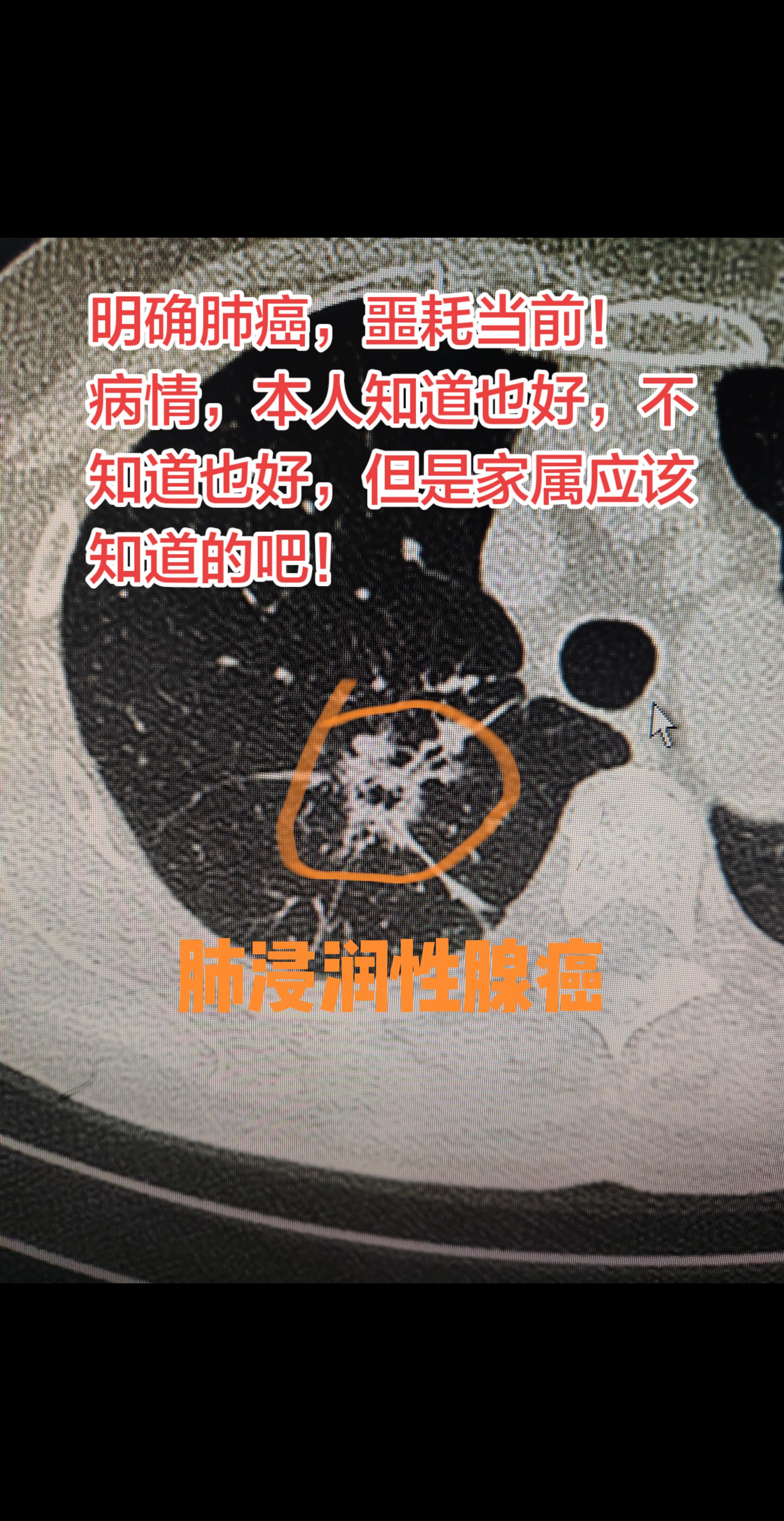 肺癌确诊后，该先告知本人还是家属？📜 法律规定 正常成年人有知晓自身...