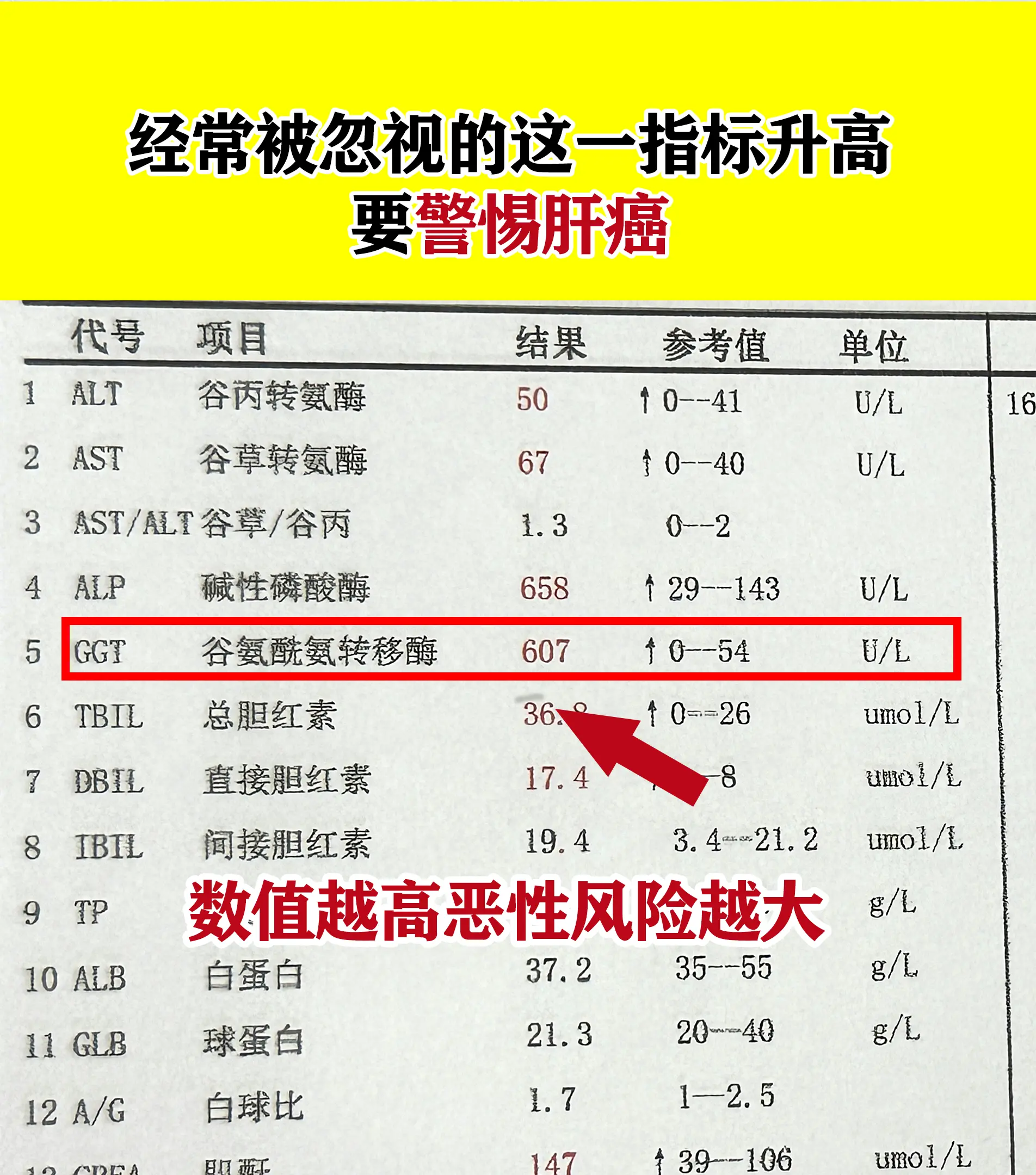 很多肝病患者复查只关注转氨酶，却常常忽视GGT（谷氨酰转肽酶）这一关键...