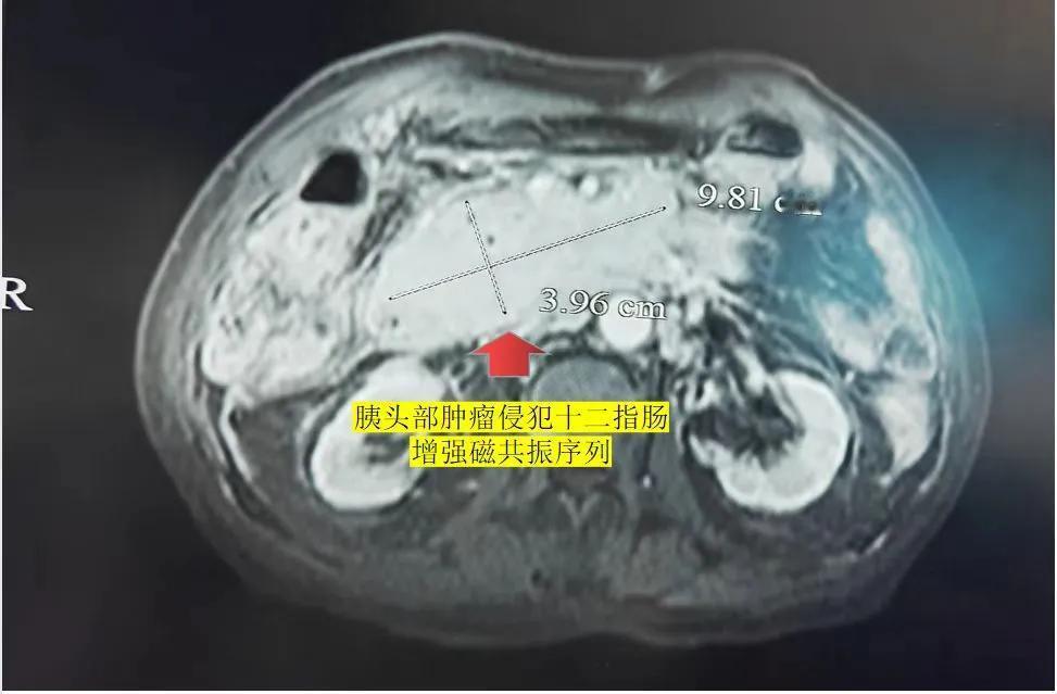 胰腺癌治疗难,如何延长生命?这是一名晚期胰腺癌患者，肿瘤最大径超过9厘米，侵犯