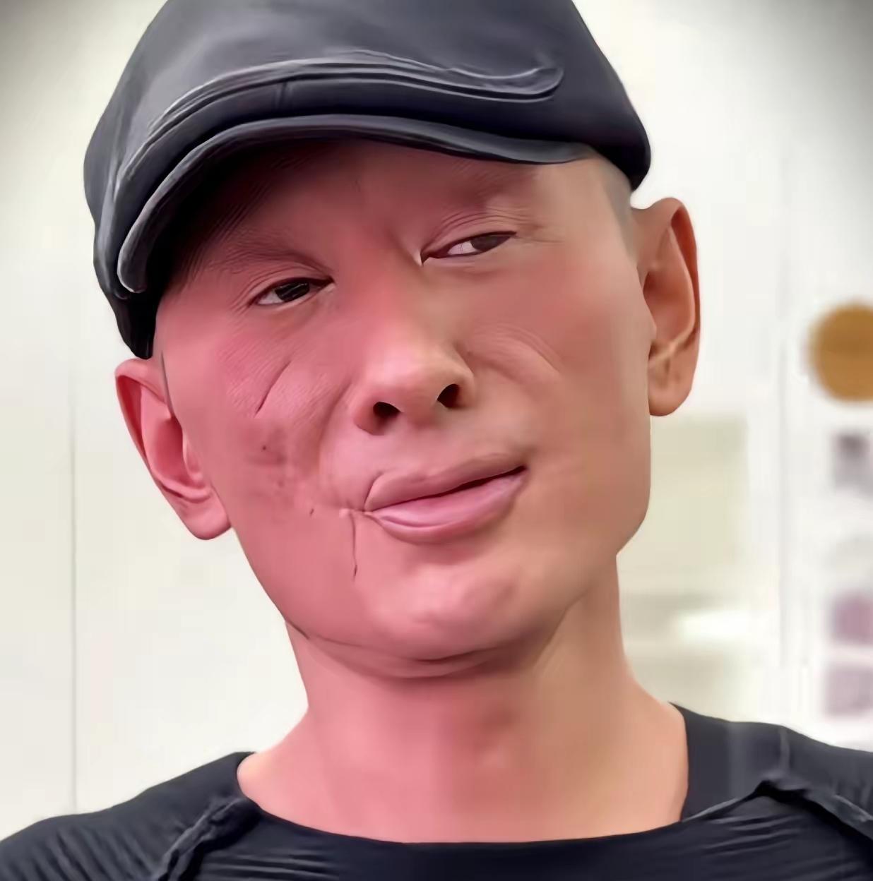 57岁阿宝近照在网络曝光，嘴角疤痕清晰可见，面部状态僵硬，不少网友看到照片后惊呼
