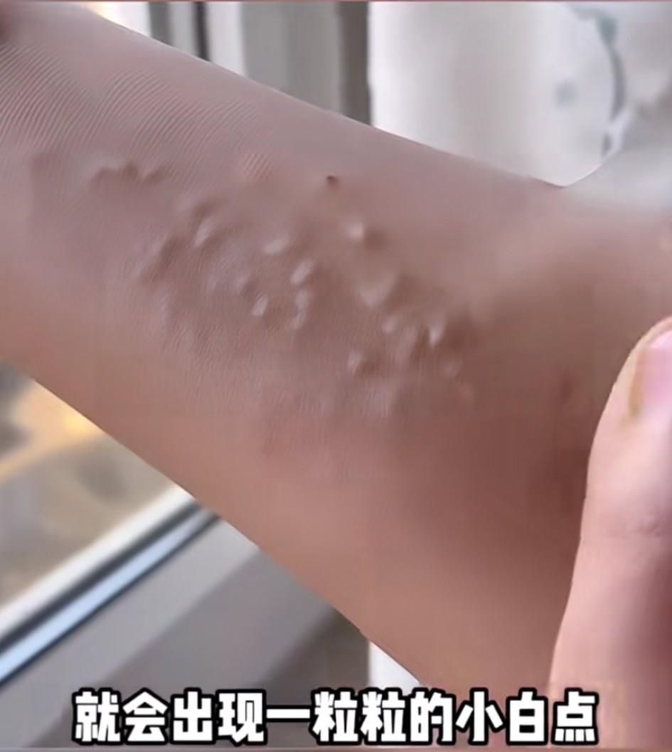 女子按压手臂后，手部会出现一粒粒“小点点”似的疙瘩！有谁知道这是什么，又是什么原